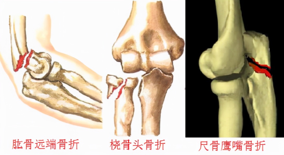 胳膊肘关节骨折后是否要实施手术治疗？