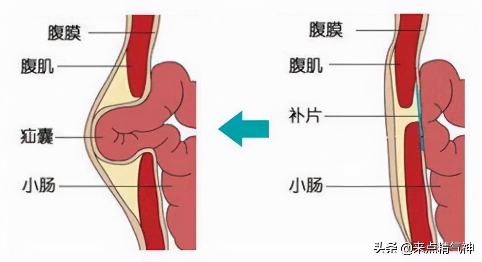 小肠疝气：避免尴尬的足部调理法